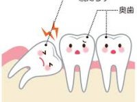 親知らずの抜歯治療