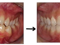 シドニーで“確実に・無駄なく”歯科矯正を始めたい方へ😊♦♦