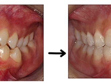 シドニーで“確実に・無駄なく”歯科矯正を始めたい方へ😊♦♦