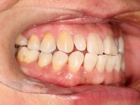 どんな歯並びだと歯科矯正するべき?