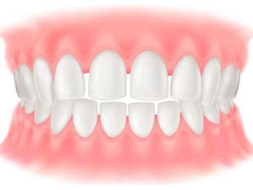 *すきっ歯（前歯の隙間）と滑舌・発音