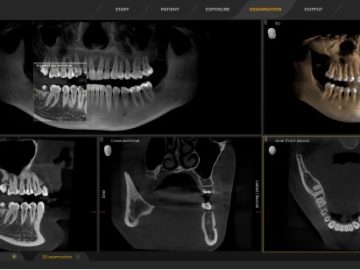 歯科用CT：低被ばくで確実な診査診断を実現するデジタルレントゲン♦♦