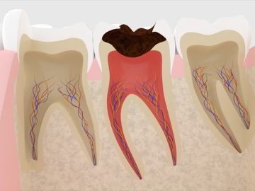 ♥Root canal treatment　歯の根の治療（根管治療）って何？