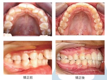 インビザライン矯正なら、未来の笑顔をもっと身近に😊
