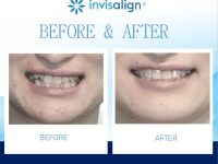 世界基準のインビザライン治療を、ANBIデンタルクリニックで 😊♦♦